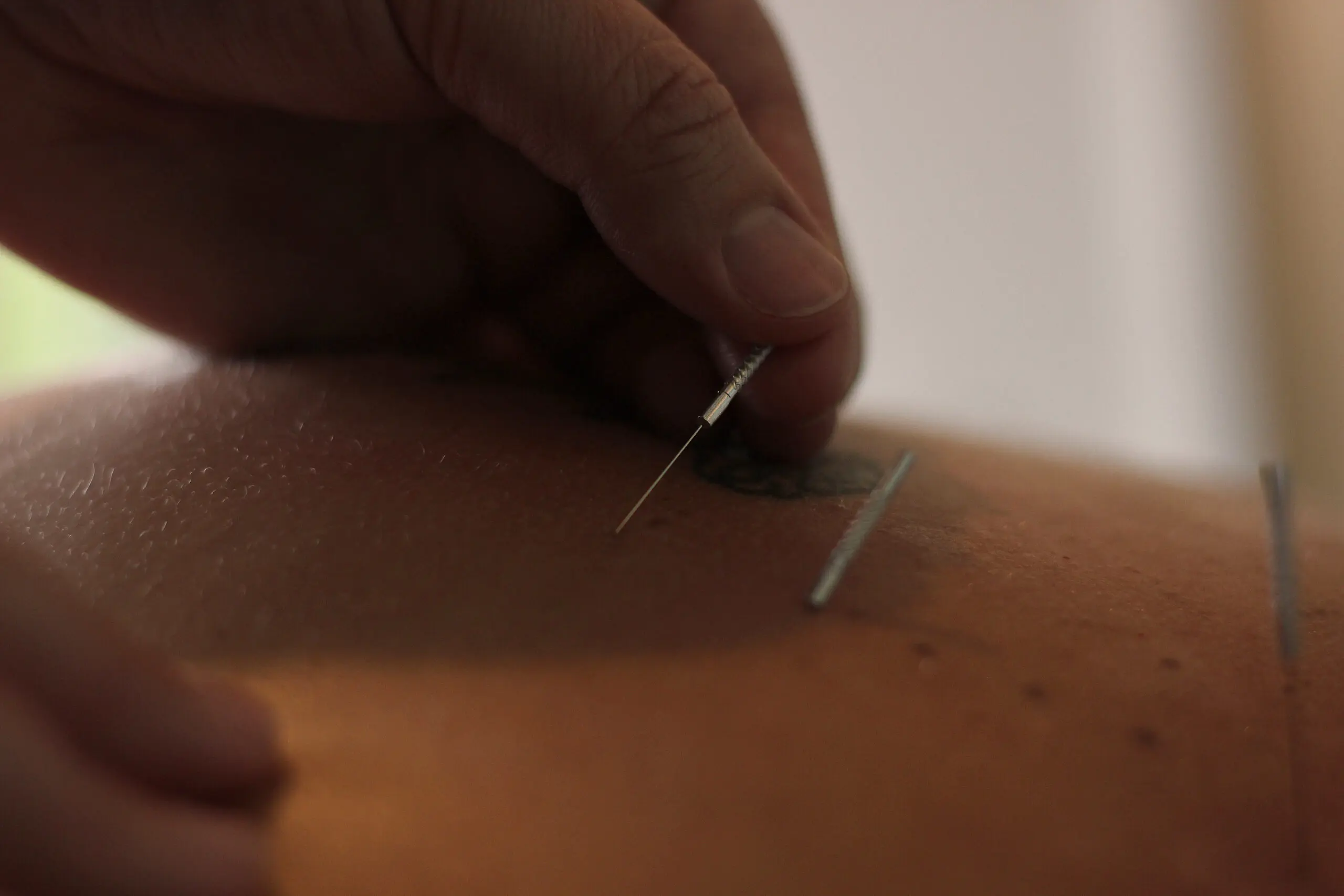 Dry Needling